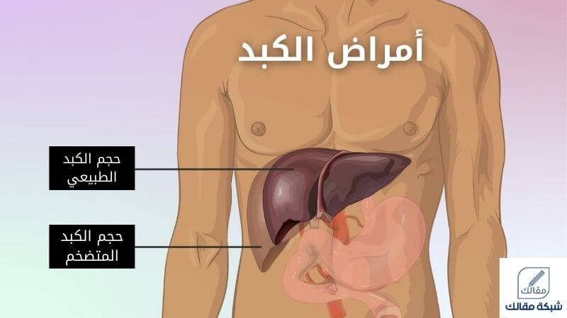 أمراض الكبد