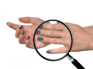 علاج الإكزيما.