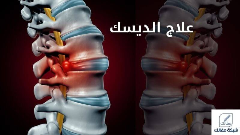 علاج الديسك