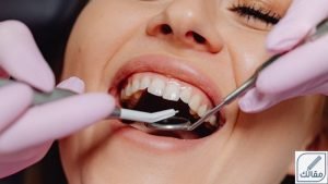 التهاب اللثة