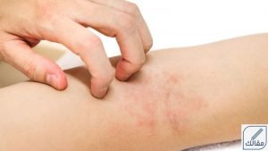 علاج الأكزيما
